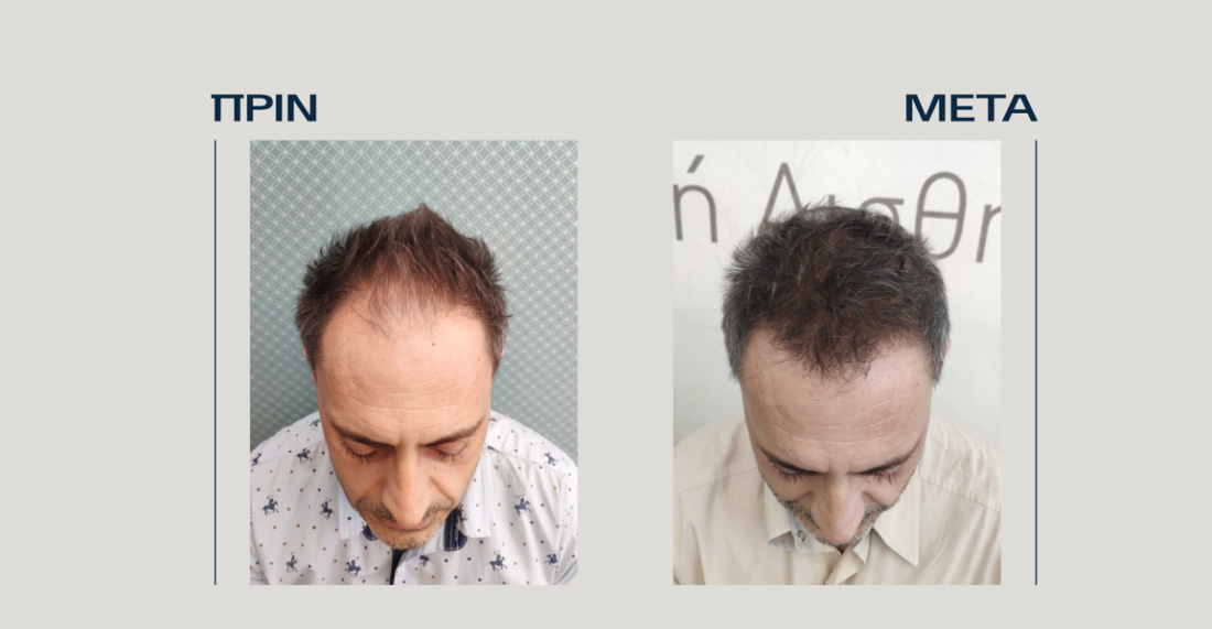 FUE Hair Transplantation offer
